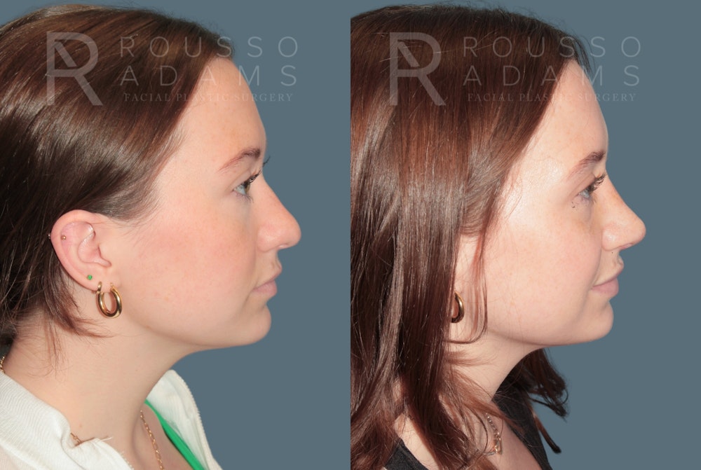 Rhinoplasty<span class=small>By Dr. Austin Adams</span> Before & After Gallery - Patient 331336 - Image 1