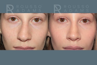 Rhinoplasty<span class=small>By Dr. Austin Adams</span> Before & After Gallery - Patient 128518 - Image 4