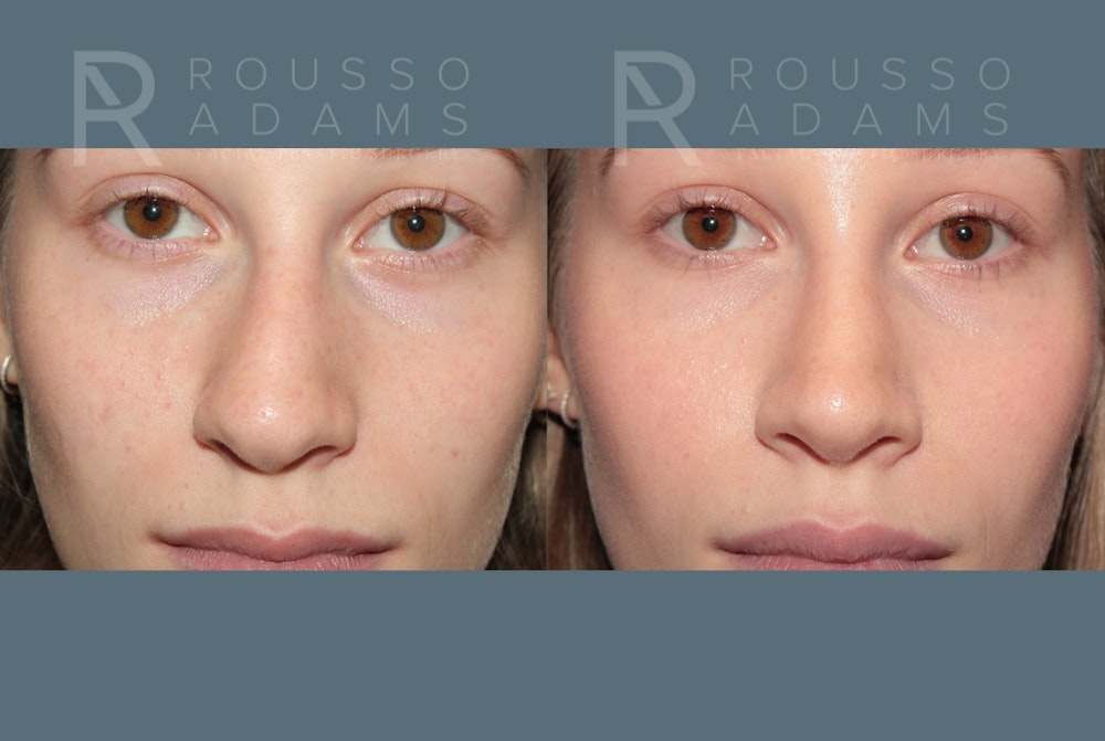 Rhinoplasty<span class=small>By Dr. Austin Adams</span> Before & After Gallery - Patient 128518 - Image 4
