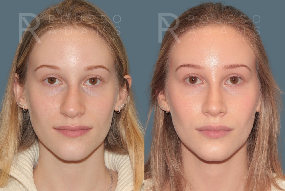 Rhinoplasty<span class=small>By Dr. Austin Adams</span> Before & After Gallery - Patient 128518 - Image 3