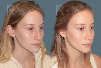 Rhinoplasty<span class=small>By Dr. Austin Adams</span> Before & After Gallery - Patient 128518 - Image 2