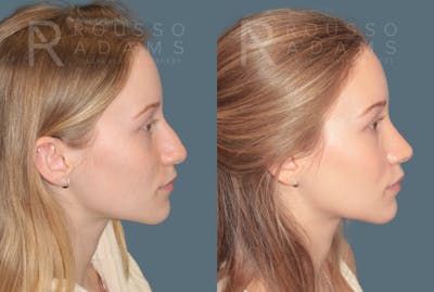 Rhinoplasty<span class=small>By Dr. Austin Adams</span> Before & After Gallery - Patient 128518 - Image 1