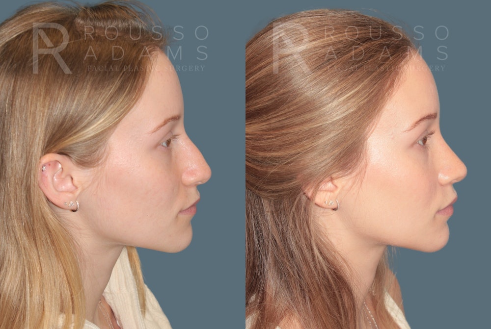 Rhinoplasty<span class=small>By Dr. Austin Adams</span> Before & After Gallery - Patient 128518 - Image 1