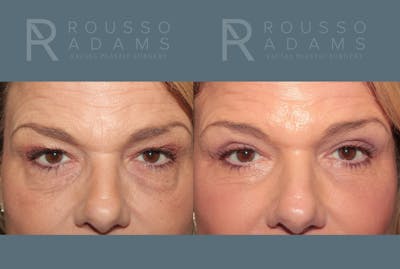 Blepharoplasty<span class=small>By Dr. Austin Adams</span> Before & After Gallery - Patient 297243 - Image 1
