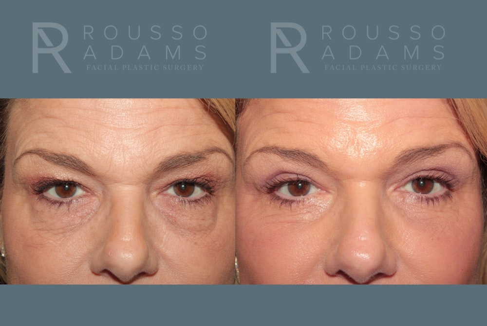 Skin Rejuvenation<span class=small>By Dr. Austin Adams</span> Before & After Gallery - Patient 135132 - Image 2