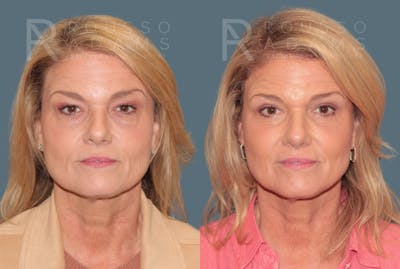Skin Rejuvenation<span class=small>By Dr. Austin Adams</span> Before & After Gallery - Patient 135132 - Image 4