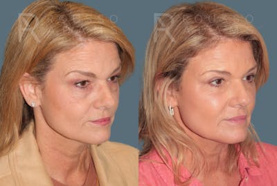 Blepharoplasty<span class=small>By Dr. Austin Adams</span> Before & After Gallery - Patient 297243 - Image 2