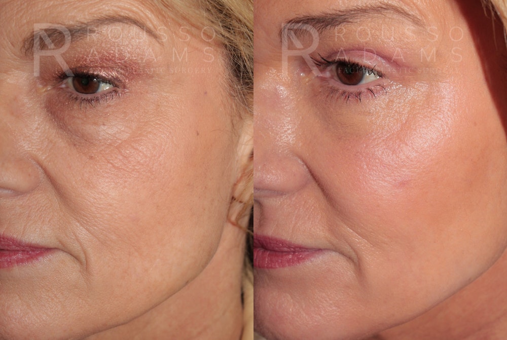 Skin Rejuvenation<span class=small>By Dr. Austin Adams</span> Before & After Gallery - Patient 135132 - Image 1