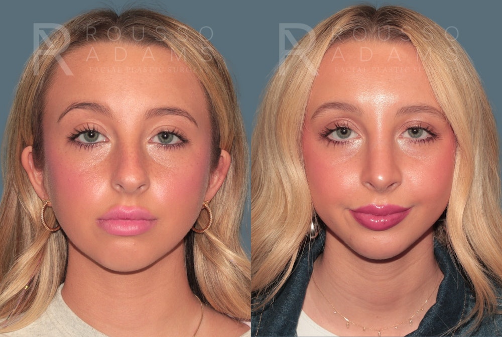 Rhinoplasty<span class=small>By Dr. Austin Adams</span> Before & After Gallery - Patient 324510 - Image 3