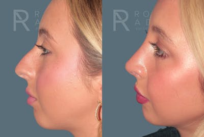 Rhinoplasty<span class=small>By Dr. Austin Adams</span> Before & After Gallery - Patient 324510 - Image 4