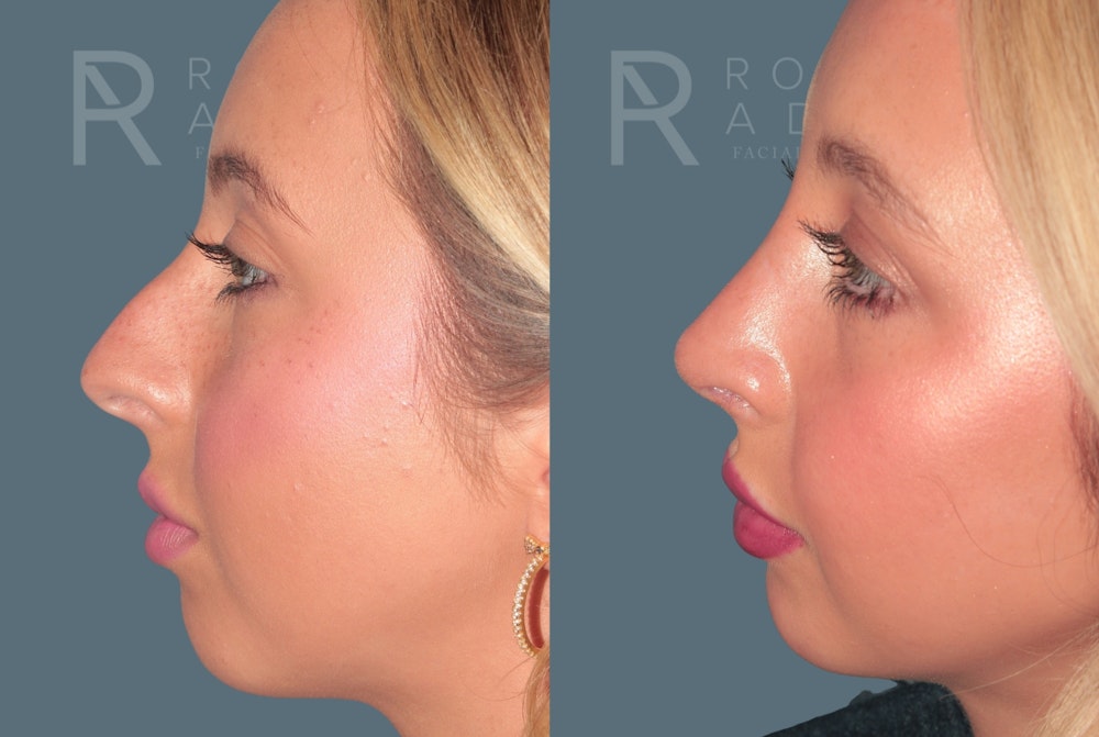 Rhinoplasty<span class=small>By Dr. Austin Adams</span> Before & After Gallery - Patient 324510 - Image 4