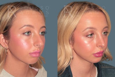 Rhinoplasty<span class=small>By Dr. Austin Adams</span> Before & After Gallery - Patient 324510 - Image 2