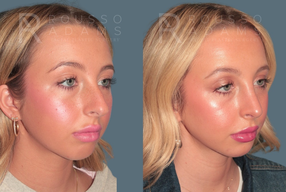Rhinoplasty<span class=small>By Dr. Austin Adams</span> Before & After Gallery - Patient 324510 - Image 2