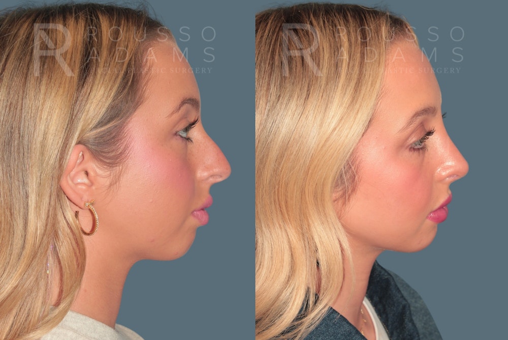 Rhinoplasty<span class=small>By Dr. Austin Adams</span> Before & After Gallery - Patient 324510 - Image 1