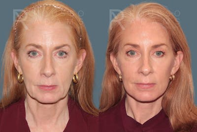 Deep Plane Facelift <span class=small>By Dr. Austin Adams</span> Before & After Gallery - Patient 123127 - Image 2