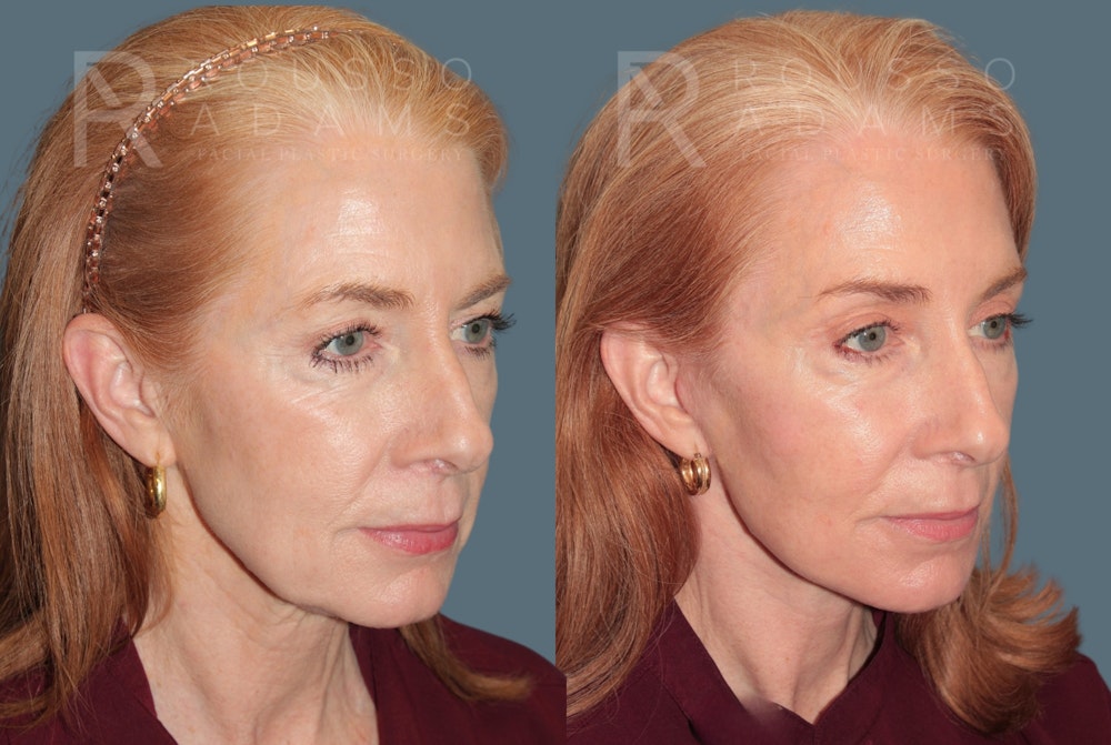 Deep Plane Facelift <span class=small>By Dr. Austin Adams</span> Before & After Gallery - Patient 123127 - Image 1