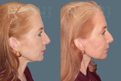 Blepharoplasty<span class=small>By Dr. Austin Adams</span> Before & After Gallery - Patient 198381 - Image 4
