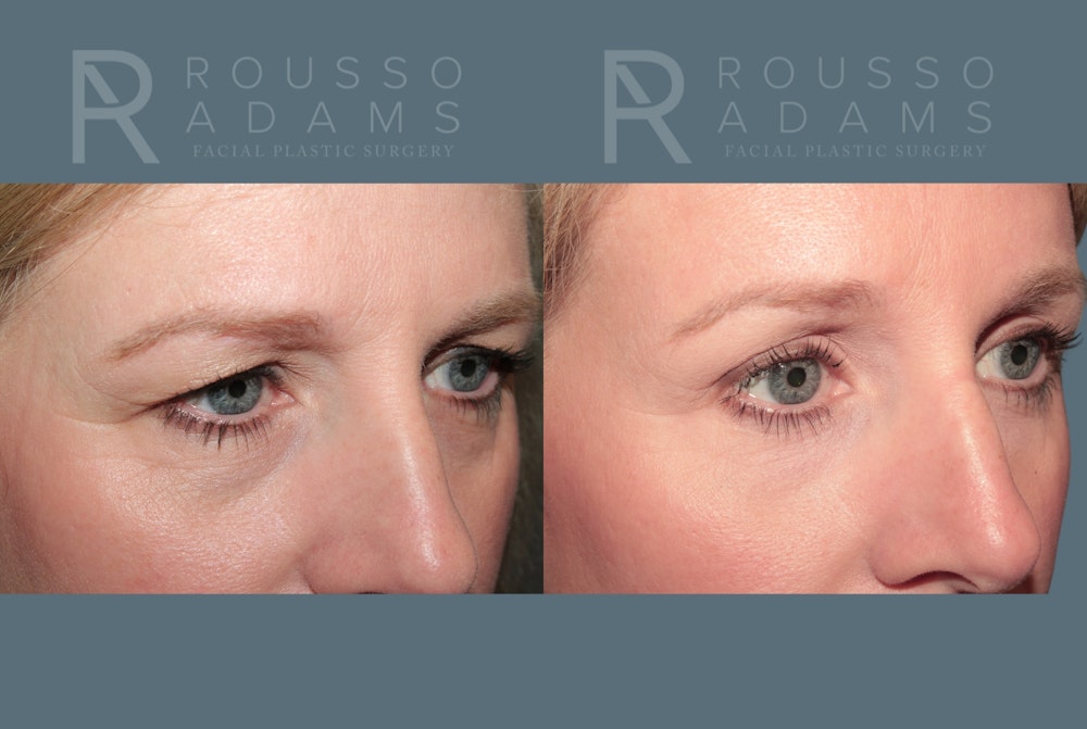 Blepharoplasty <span class=small>By Dr. Daniel Rousso</span> Before & After Gallery - Patient 871973 - Image 2