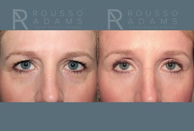 Blepharoplasty <span class=small>By Dr. Daniel Rousso</span> Before & After Gallery - Patient 871973 - Image 1