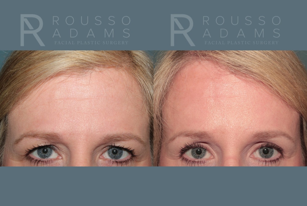 Blepharoplasty <span class=small>By Dr. Daniel Rousso</span> Before & After Gallery - Patient 871973 - Image 3