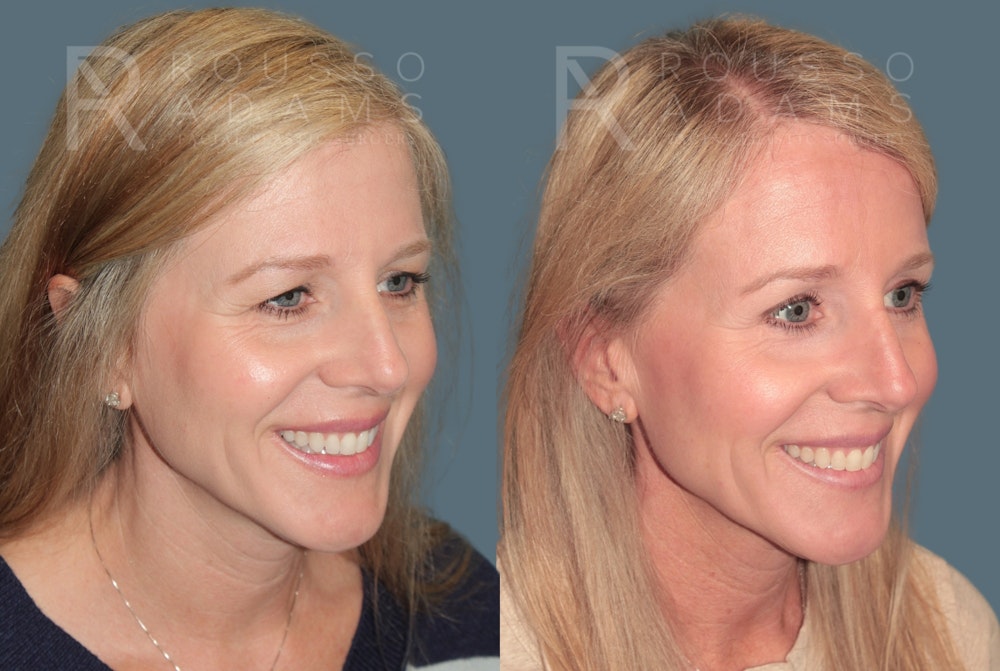 Blepharoplasty <span class=small>By Dr. Daniel Rousso</span> Before & After Gallery - Patient 871973 - Image 4