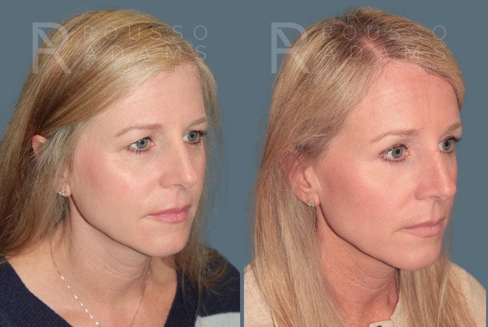 Blepharoplasty <span class=small>By Dr. Daniel Rousso</span> Before & After Gallery - Patient 871973 - Image 5