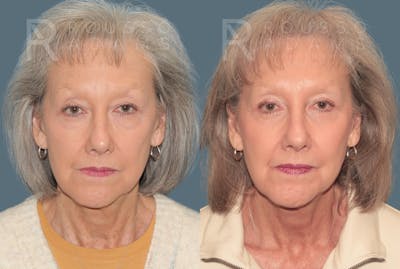 Blepharoplasty <span class=small>By Dr. Daniel Rousso</span> Before & After Gallery - Patient 387811 - Image 4