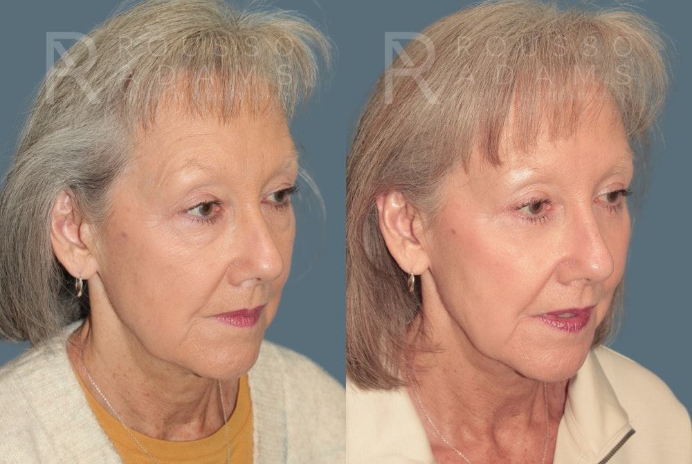 Blepharoplasty <span class=small>By Dr. Daniel Rousso</span> Before & After Gallery - Patient 387811 - Image 3