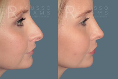 Rhinoplasty <span class=small>By Dr. Daniel Rousso</span> Before & After Gallery - Patient 118348 - Image 2