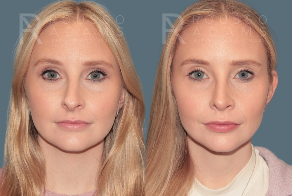 Rhinoplasty <span class=small>By Dr. Daniel Rousso</span> Before & After Gallery - Patient 118348 - Image 4