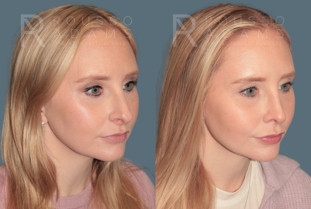Rhinoplasty <span class=small>By Dr. Daniel Rousso</span> Before & After Gallery - Patient 118348 - Image 3