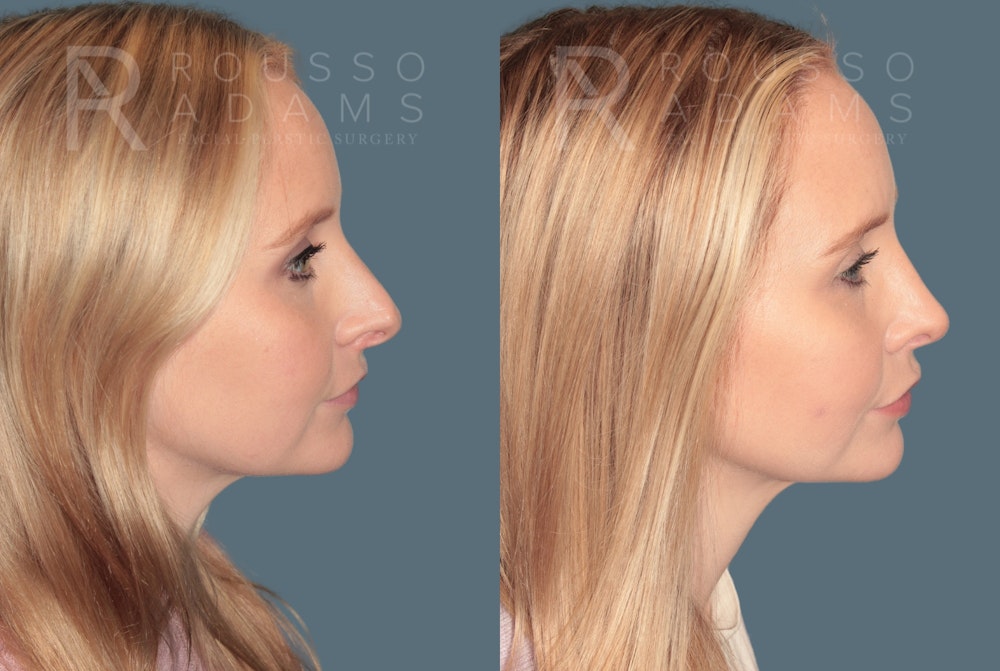 Rhinoplasty <span class=small>By Dr. Daniel Rousso</span> Before & After Gallery - Patient 118348 - Image 1