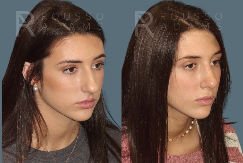 Rhinoplasty <span class=small>By Dr. Daniel Rousso</span> Before & After Gallery - Patient 299973 - Image 3