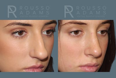 Rhinoplasty <span class=small>By Dr. Daniel Rousso</span> Before & After Gallery - Patient 299973 - Image 4
