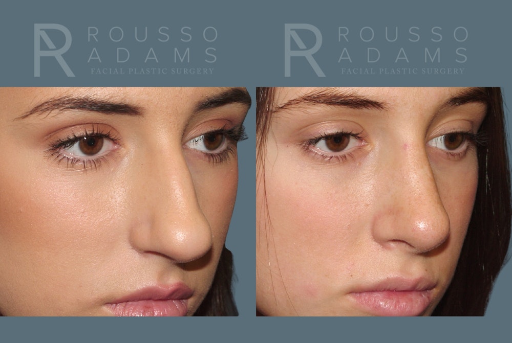 Rhinoplasty <span class=small>By Dr. Daniel Rousso</span> Before & After Gallery - Patient 299973 - Image 4