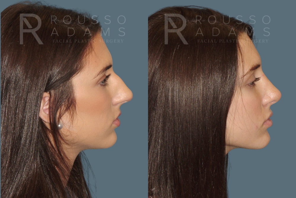 Rhinoplasty <span class=small>By Dr. Daniel Rousso</span> Before & After Gallery - Patient 299973 - Image 1
