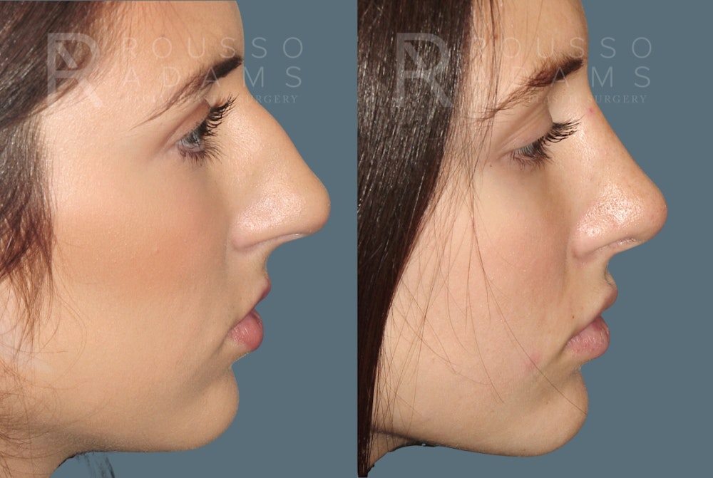 Rhinoplasty <span class=small>By Dr. Daniel Rousso</span> Before & After Gallery - Patient 299973 - Image 2