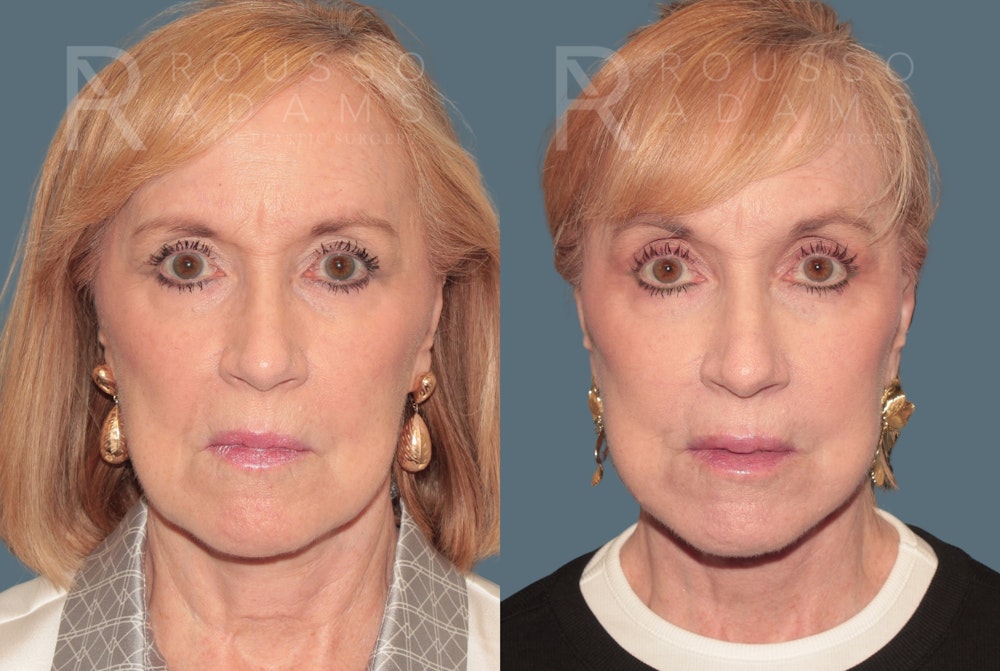 SculptLift™ <span class=small>By Dr. Daniel Rousso</span> Before & After Gallery - Patient 360940 - Image 3
