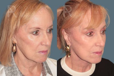 SculptLift™ <span class=small>By Dr. Daniel Rousso</span> Before & After Gallery - Patient 360940 - Image 1
