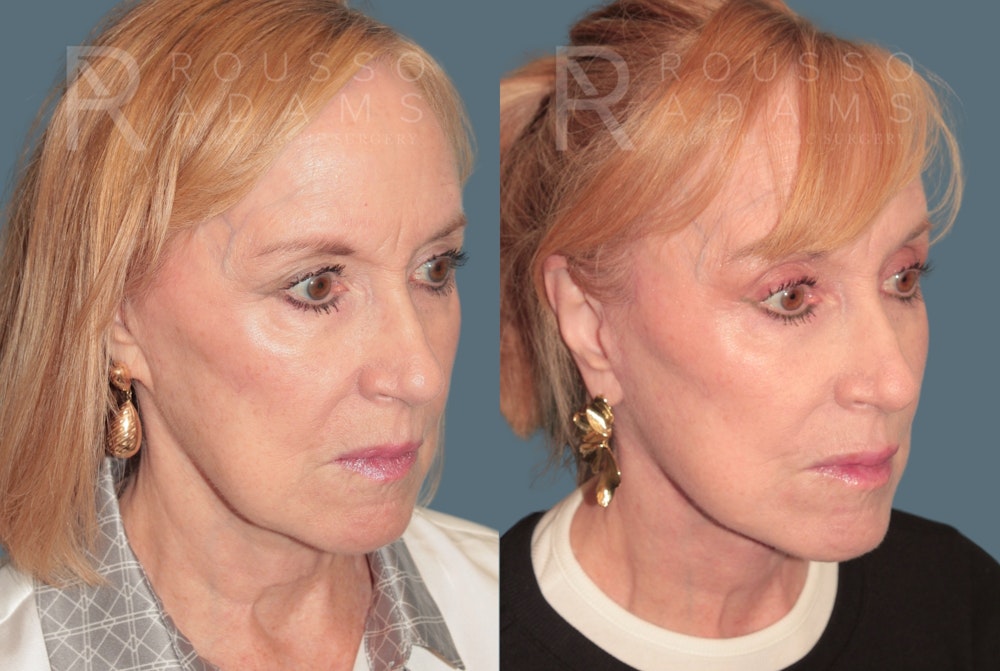 SculptLift™ <span class=small>By Dr. Daniel Rousso</span> Before & After Gallery - Patient 360940 - Image 1