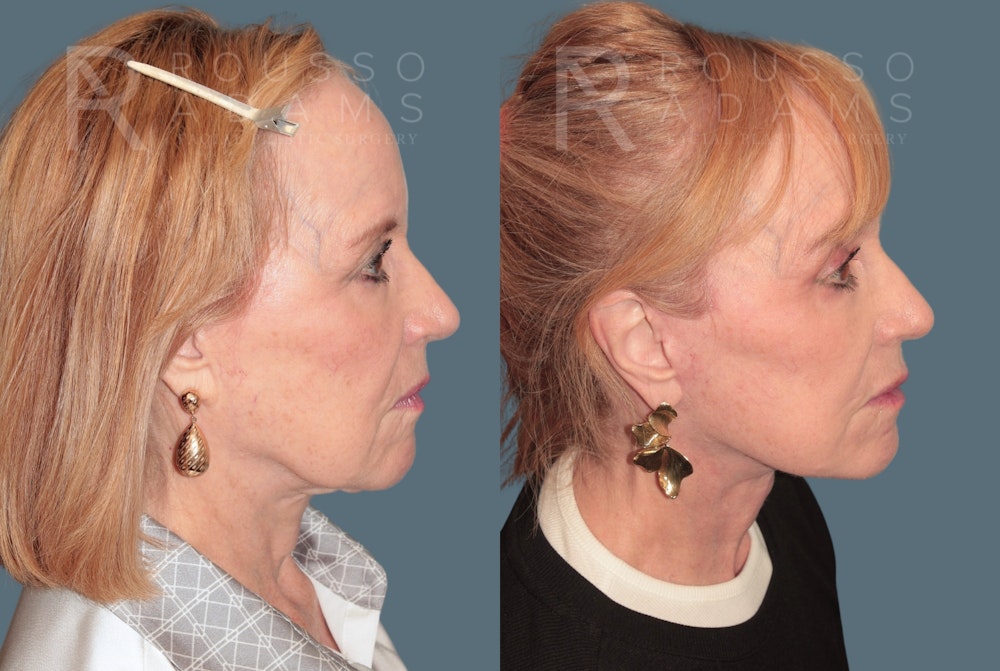 SculptLift™ <span class=small>By Dr. Daniel Rousso</span> Before & After Gallery - Patient 360940 - Image 4