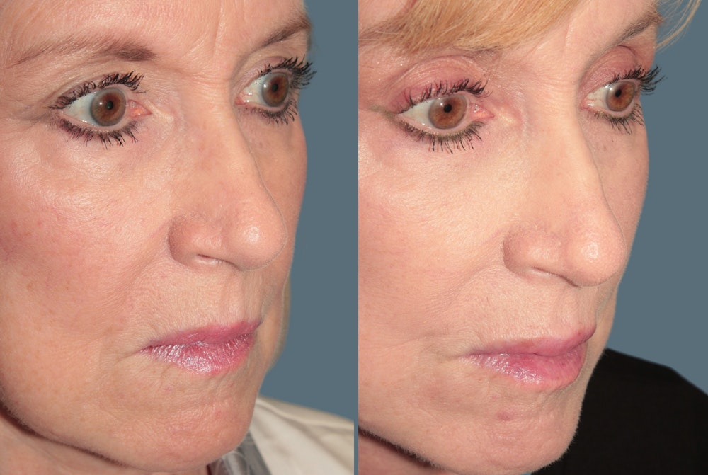 SculptLift™ <span class=small>By Dr. Daniel Rousso</span> Before & After Gallery - Patient 360940 - Image 2
