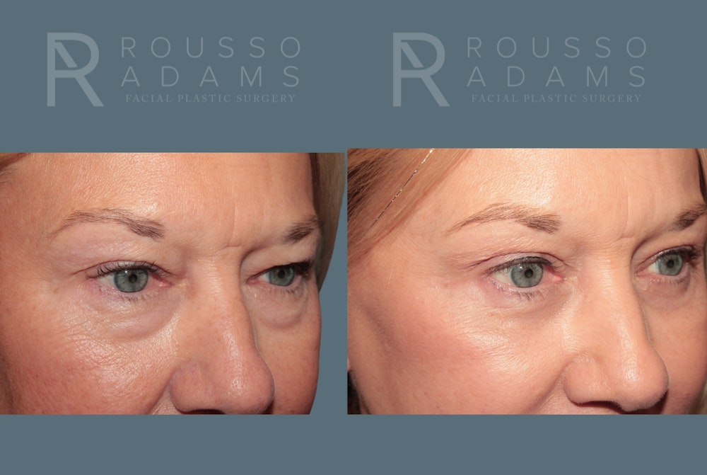 Deep Plane Facelift <span class=small>By Dr. Daniel Rousso</span> Before & After Gallery - Patient 248384 - Image 5