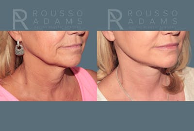 Deep Plane Facelift <span class=small>By Dr. Daniel Rousso</span> Before & After Gallery - Patient 248384 - Image 6