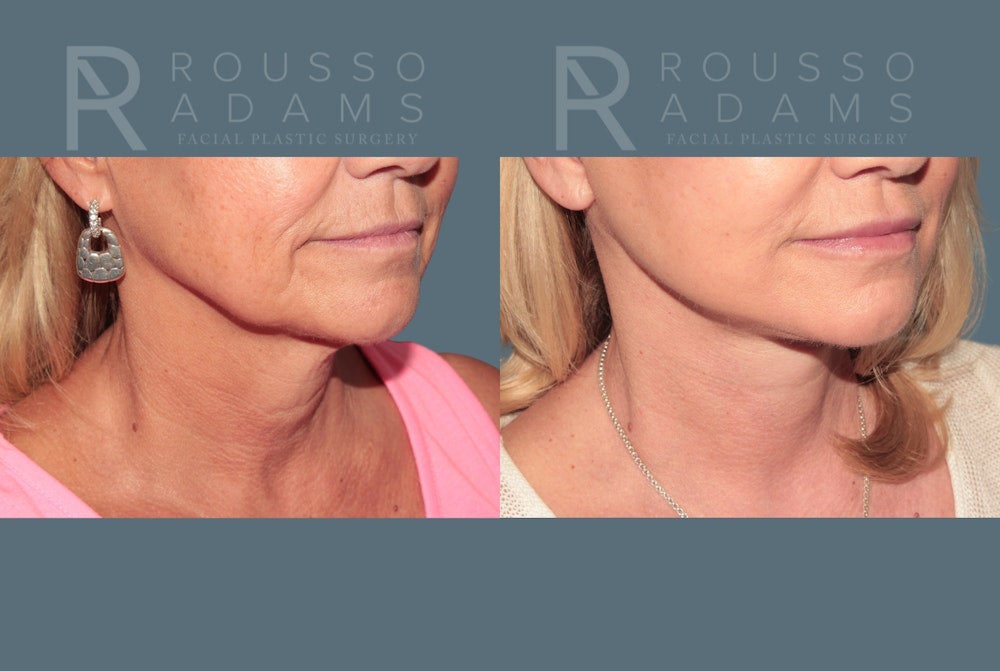Deep Plane Facelift <span class=small>By Dr. Daniel Rousso</span> Before & After Gallery - Patient 248384 - Image 6