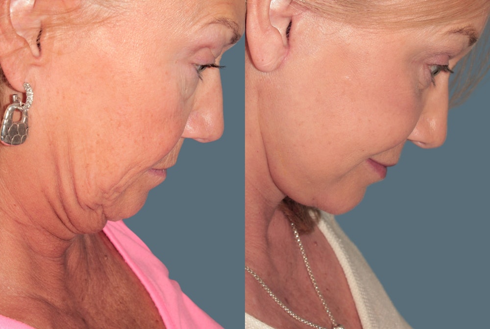 Deep Plane Facelift <span class=small>By Dr. Daniel Rousso</span> Before & After Gallery - Patient 248384 - Image 7