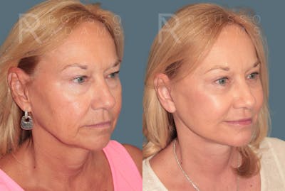 Deep Plane Facelift <span class=small>By Dr. Daniel Rousso</span> Before & After Gallery - Patient 248384 - Image 1