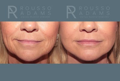 Deep Plane Facelift <span class=small>By Dr. Daniel Rousso</span> Before & After Gallery - Patient 248384 - Image 4