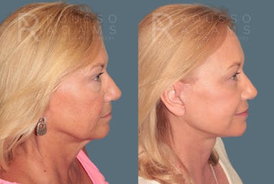 Deep Plane Facelift <span class=small>By Dr. Daniel Rousso</span> Before & After Gallery - Patient 248384 - Image 2