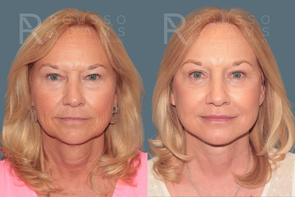 Deep Plane Facelift <span class=small>By Dr. Daniel Rousso</span> Before & After Gallery - Patient 248384 - Image 3